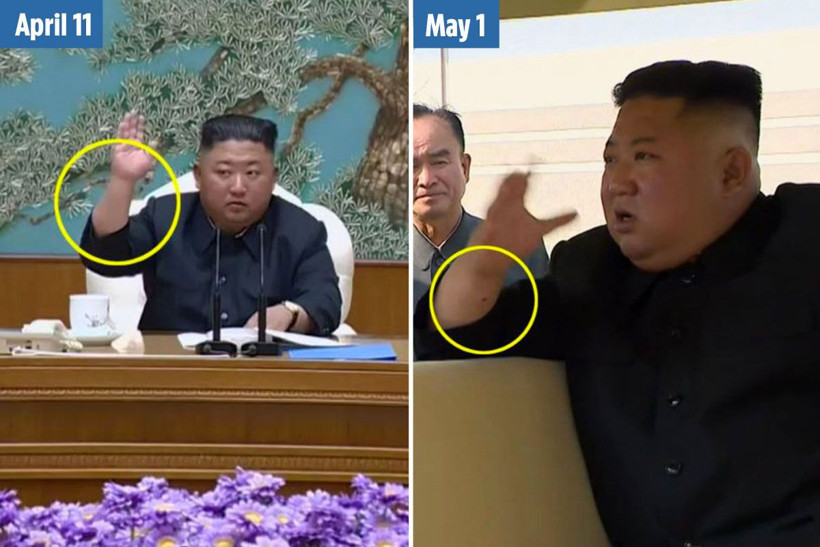 Kuzey Kore lideri Kim Joung-un'un kolundaki izler ne? Yakın dostu herşeyi açıkladı - Resim: 4