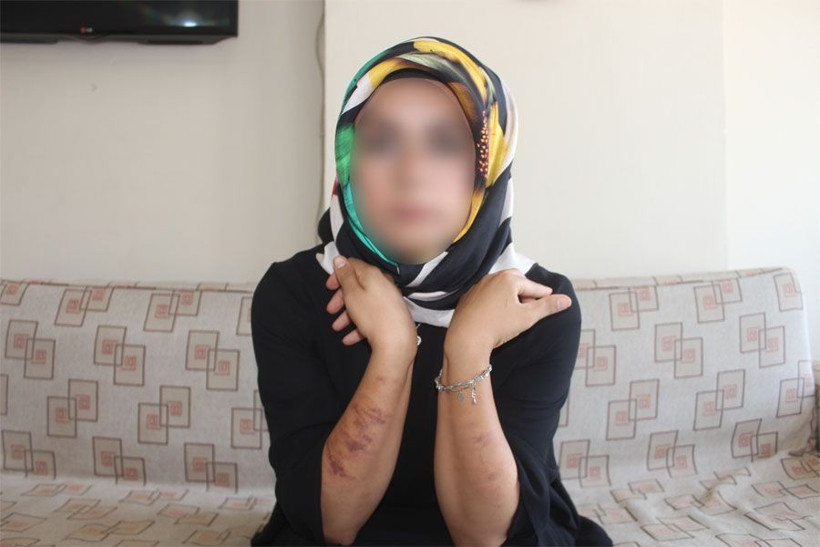 Adıyaman'da güzellik merkezinde lazer epilasyon yaptıran kadının vücudu yandı! - Resim: 3