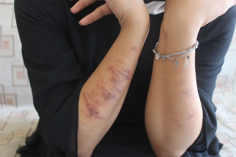 Adıyaman'da güzellik merkezinde lazer epilasyon yaptıran kadının vücudu yandı! - Resim: 4