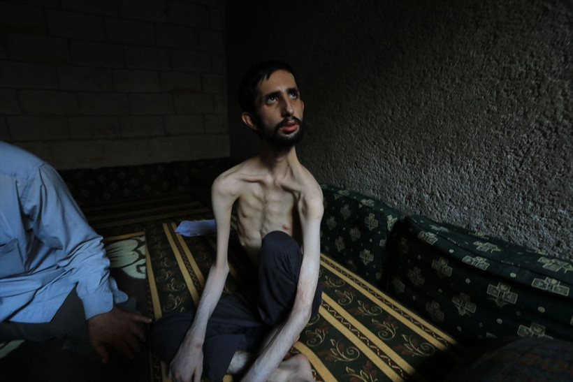 18 yaşındaki Abdullah'ın hali yürekleri burktu! 35 kiloya düştü günden güne eriyor - Resim: 3