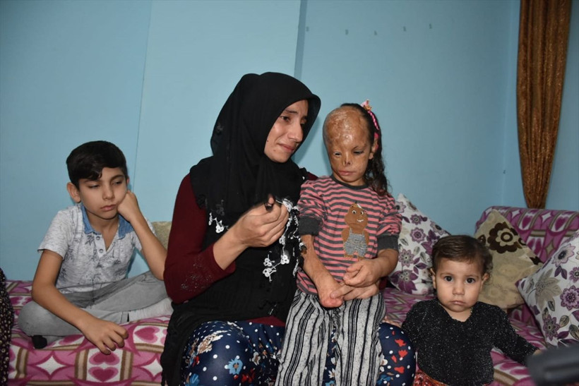 6 aylıkken yanan Dilara dış görünüşü nedeniyle zor günler geçiriyor - Resim: 1