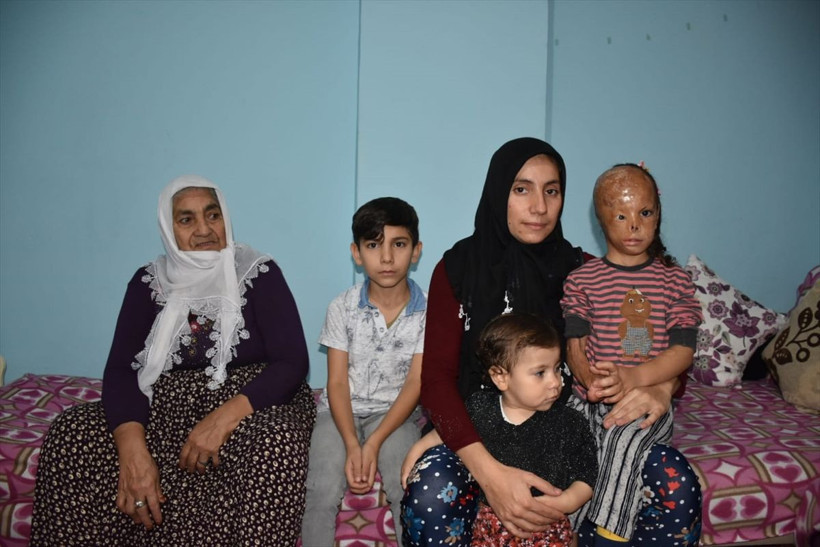 6 aylıkken yanan Dilara dış görünüşü nedeniyle zor günler geçiriyor - Resim: 2