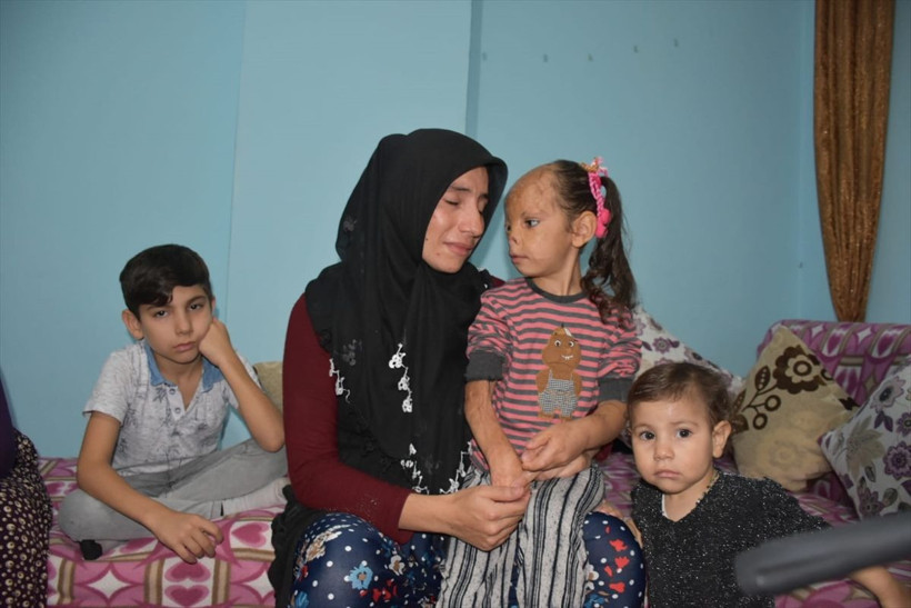 6 aylıkken yanan Dilara dış görünüşü nedeniyle zor günler geçiriyor - Resim: 3