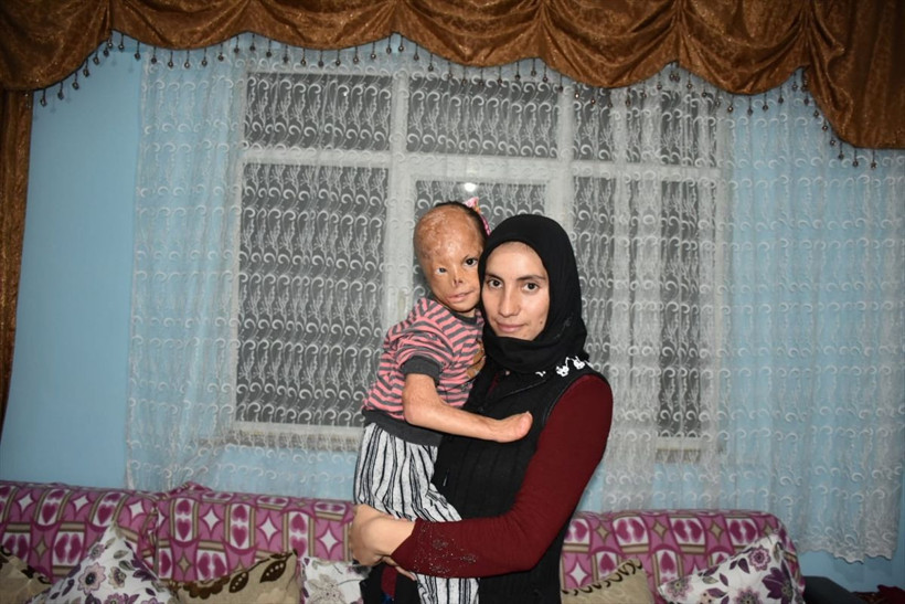 6 aylıkken yanan Dilara dış görünüşü nedeniyle zor günler geçiriyor - Resim: 4