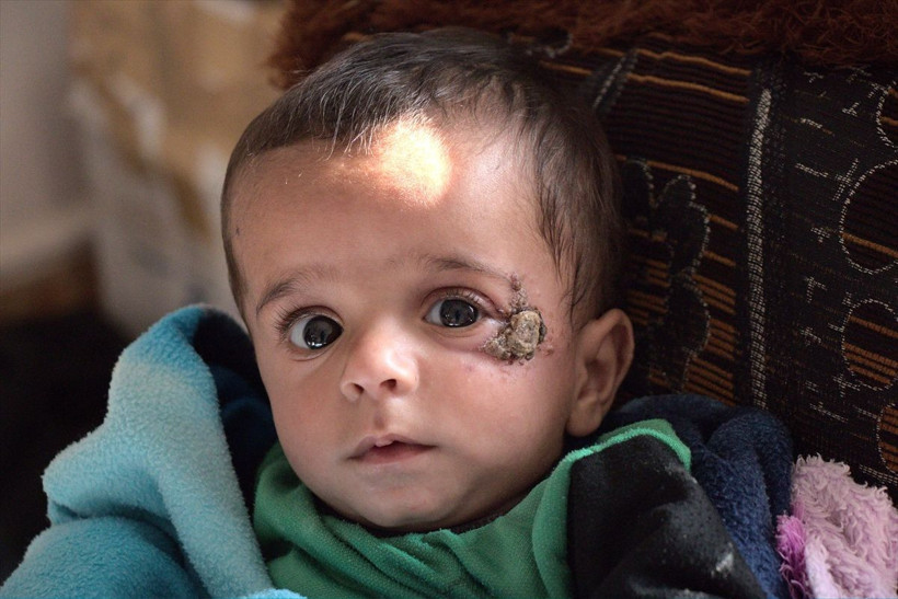 Barış Pınarı bölgesinde korkutan salgın! Özellikler çocukları vuruyor 'şark çıbanı' alarmı - Resim: 3