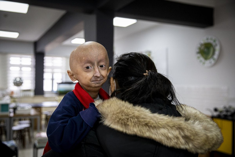 Yaşını duyan kimse inanamadı! Bu hastalık Türkiye'de sadece 4 kişide var: Hemen arkamıza saklanıyor - Resim: 2