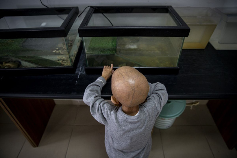 Yaşını duyan kimse inanamadı! Bu hastalık Türkiye'de sadece 4 kişide var: Hemen arkamıza saklanıyor - Resim: 3