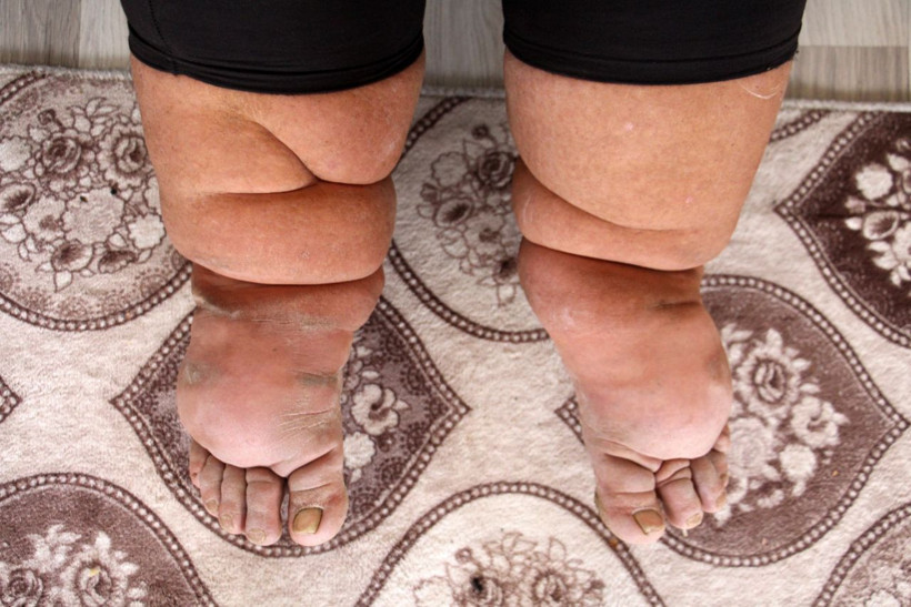 Çok farklı bir hastalığı var ayakları sürekli büyüyor! Sivas'ta bu adamı görenler şoke oluyor - Resim: 3