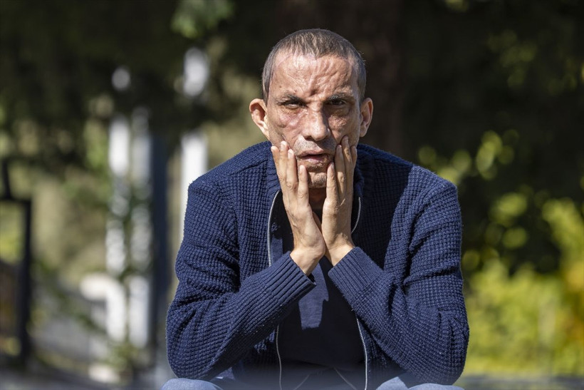 Türkiye'de ilk yüz nakli yapılan isimlerdi! Uğur Acar ve Turan Çolak'ın 10 yıl sonraki haline bakın - Resim: 2