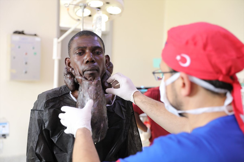 Sakal gibi uzayan 'keloid' şaşkına çevirdi! Ugandalı Muhammed'i Türk doktorlar kurtardı - Resim: 3