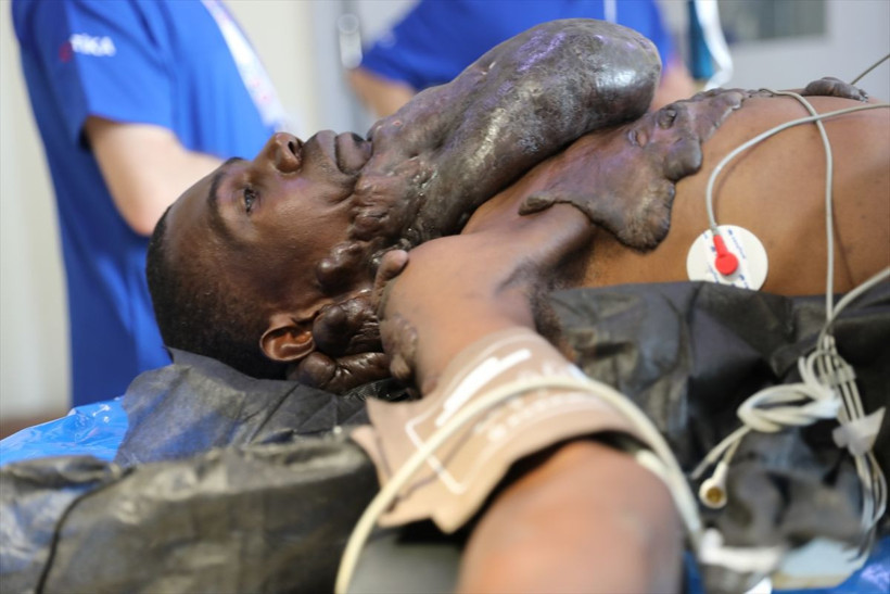 Sakal gibi uzayan 'keloid' şaşkına çevirdi! Ugandalı Muhammed'i Türk doktorlar kurtardı - Resim: 4