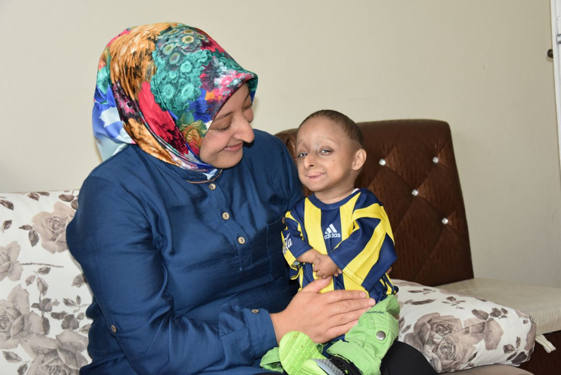 Hastalığı milyonda bir görülüyor gerçek yaşını duyan şaşkına dönüyor - Resim: 2