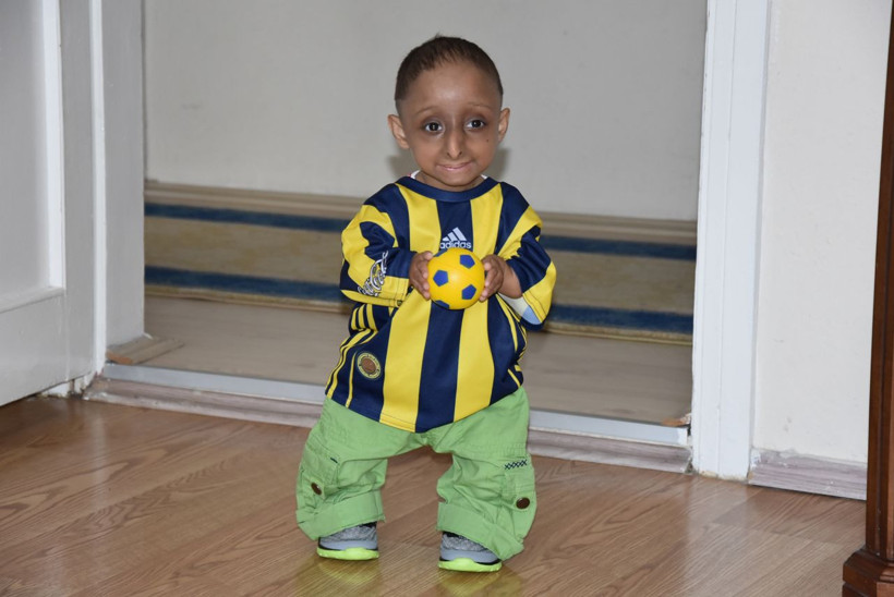 Hastalığı milyonda bir görülüyor gerçek yaşını duyan şaşkına dönüyor - Resim: 1