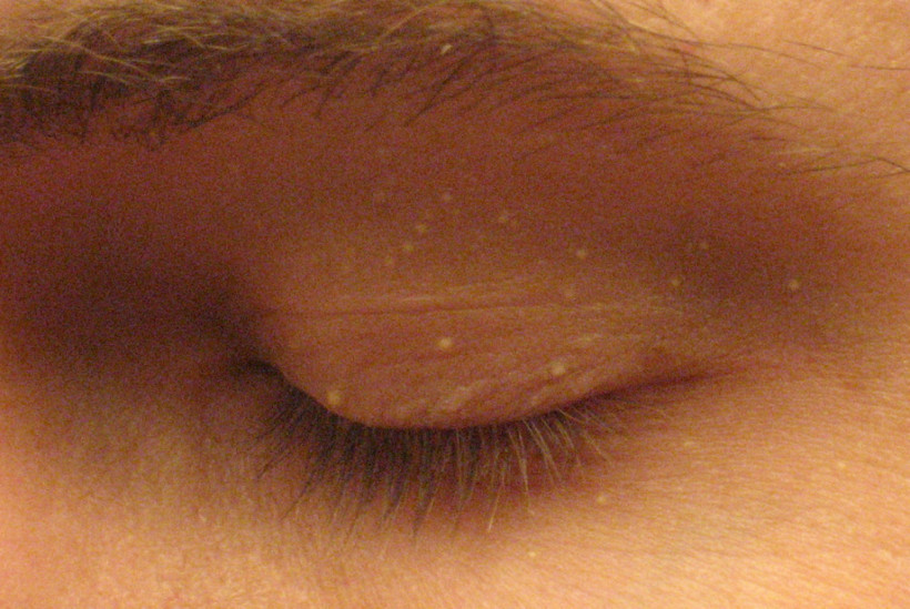 Yüzdeki küçük beyaz noktalar neden oluşur? - Resim: 2