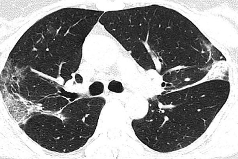 Koronavirüsünün akciğerlere verdiği zarar böyle görüntülendi - Resim: 3
