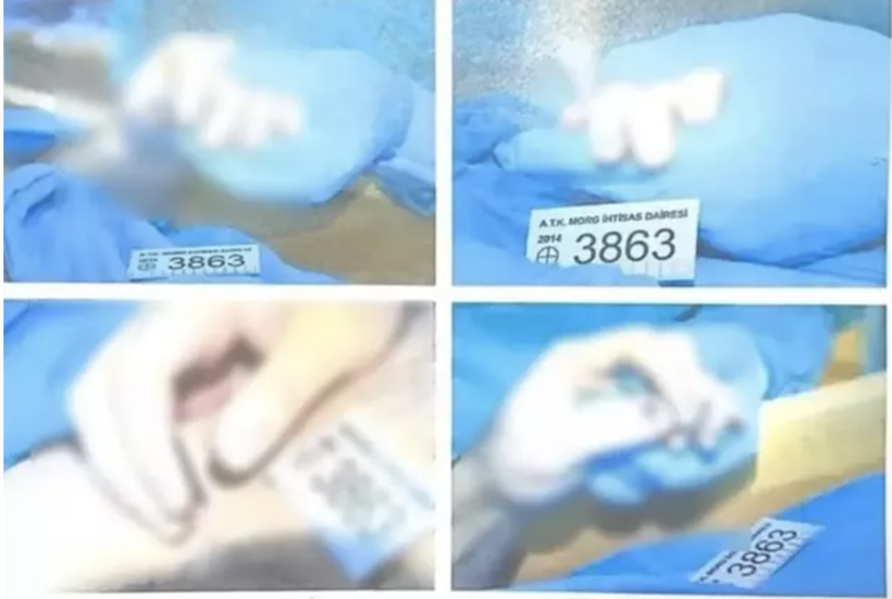 Garipoğlu'nun otopsi fotoğrafları olay olmuştu! Elindeki morlukların sırrı bakın neymiş - Resim: 4