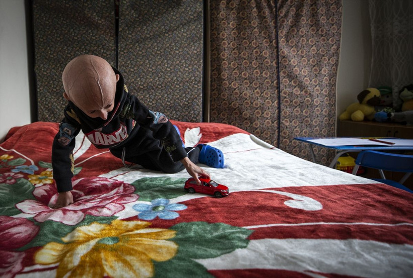 Yaşını duyan kimse inanamadı! Bu hastalık Türkiye'de sadece 4 kişide var: Hemen arkamıza saklanıyor - Resim: 4