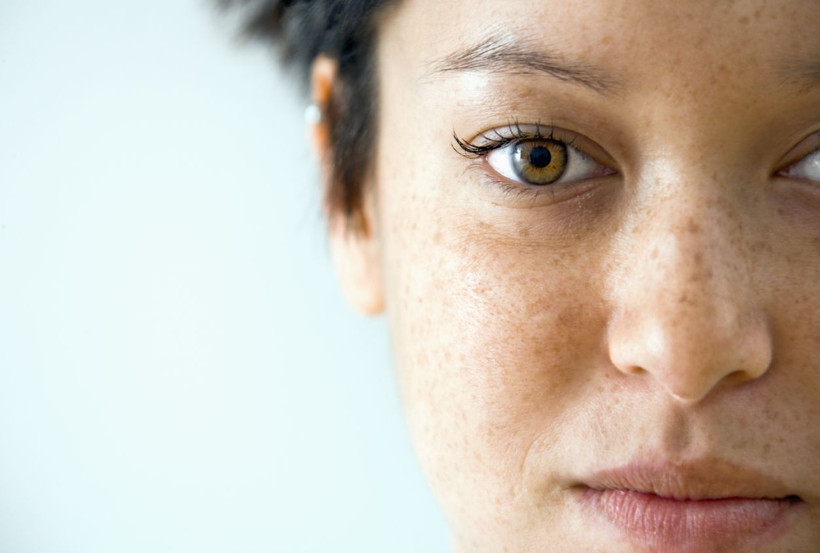 Vücuttaki güneş lekelerinden kurtulmanız için 12 mucizevi yöntem! - Resim: 3