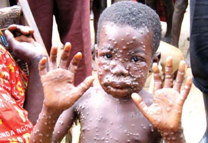 "Maymun Çiçeği hastalığı Türkiye'de" iddiası! DSÖ'den korkutan uyarı cinsel yolla bulaşıyor - Resim: 1