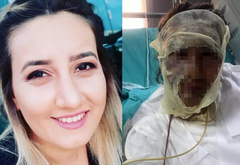 İstanbul'da yüzünü kızgın yağla yakan sevgilisi tutuklanınca affedin diye ağladı - Resim: 1