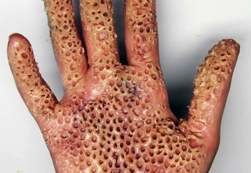 Bu fotoğrafa bakamıyor musunuz? O zaman sizde 'Tripofobik'siniz! - Resim: 1