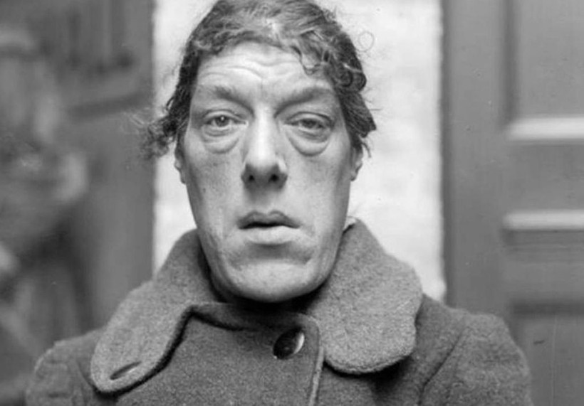 Yakalandığı hastalık sonrası bir anda dünyanın en çirkin kadını oldu - Resim: 4