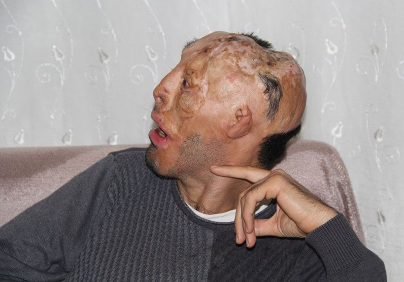 Kafatası yok beyni dışarıda Mehmet Ali'nin çığlığı - Resim: 1