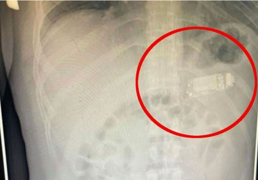 Midesinden Nokia 3310 telefon çıktı! Doktorları şaşırtan ameliyat - Resim: 3