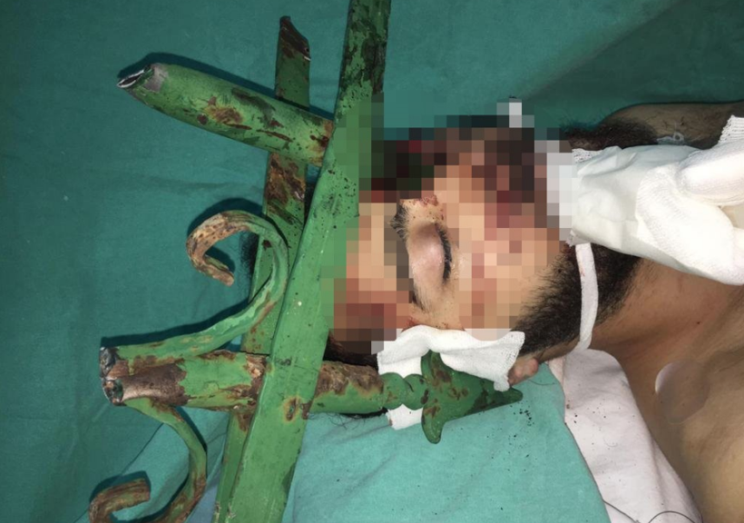 Gencin yüzüne saplanan çubuk için hastanedeki operasyona itfaiye ekibi de dahil oldu - Resim: 1