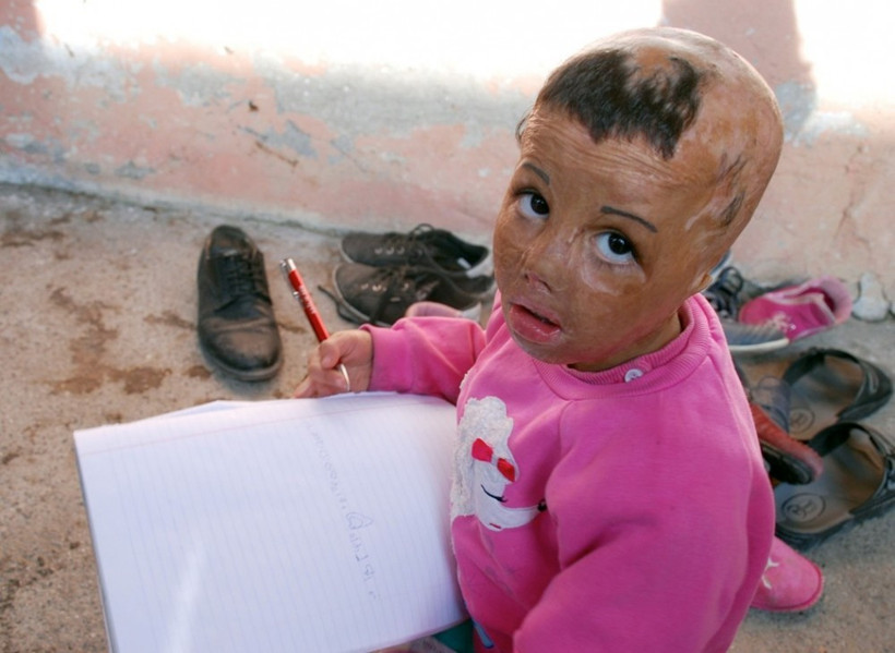 6 yaşında 7 kez ameliyat olan Rezzan'ın dramı - Resim: 1