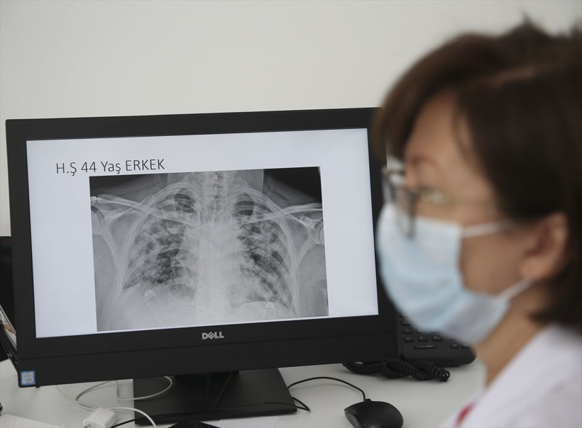 Koronavirüsün akciğerdeki ağır tahribatı hastaların tomografi görüntülerine yansıdı - Resim: 3