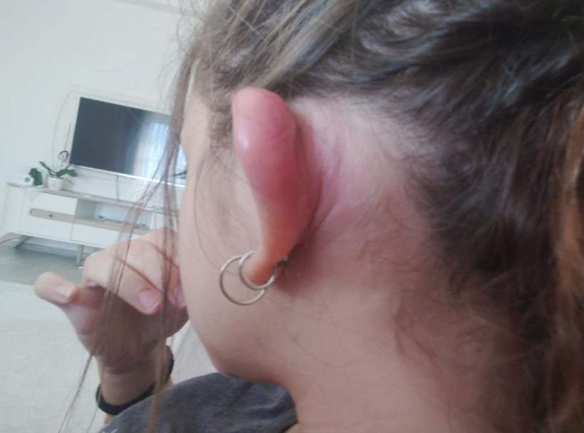 Küpe takmak için takıcıda deldirdiği kulağı hayatını kabusa çevirdi! - Resim: 4