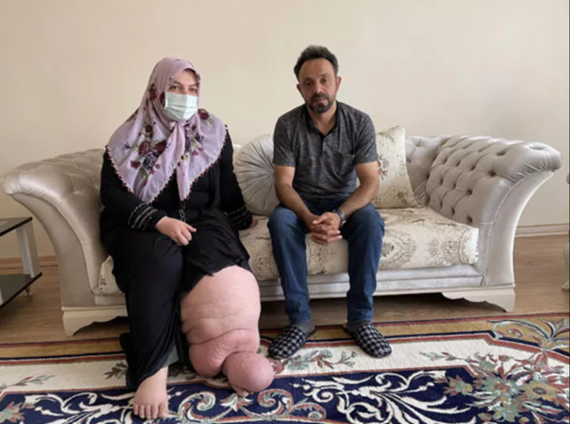 Ayağı 50 kilo oldu! Muş'ta fil hastası kadın en büyük hayaline kavuşacak: 21 yıl... - Resim: 1