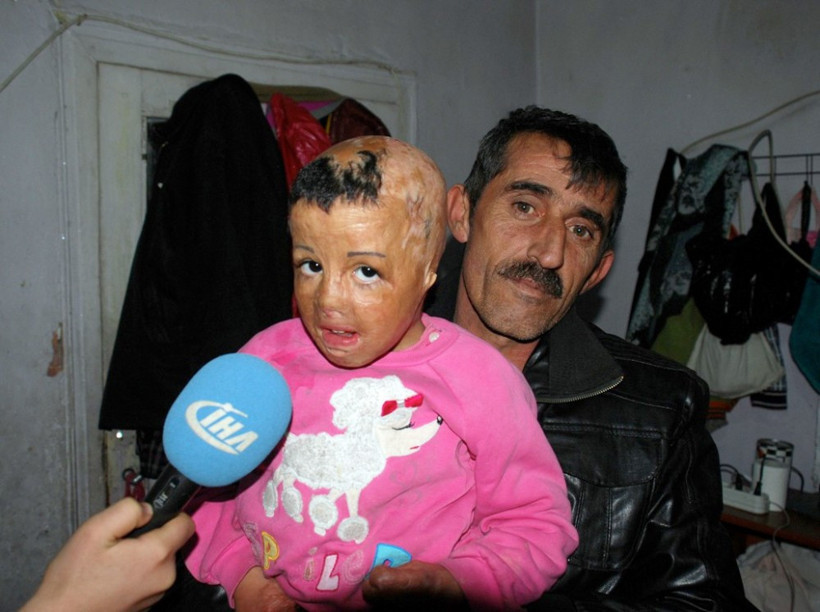 6 yaşında 7 kez ameliyat olan Rezzan'ın dramı - Resim: 3