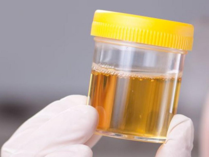 Doktorlardan uyarı: İdrarınızı içmeyin! - Resim: 4