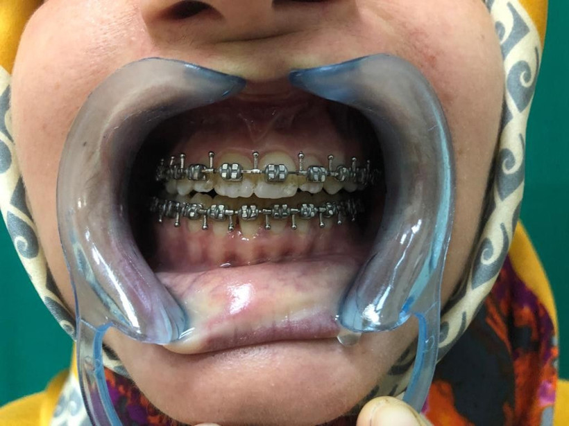 Samsun'da çene ameliyatı olan Hülya Karayiğit hem güzelliğine hem de sağlığına kavuştu - Resim: 4