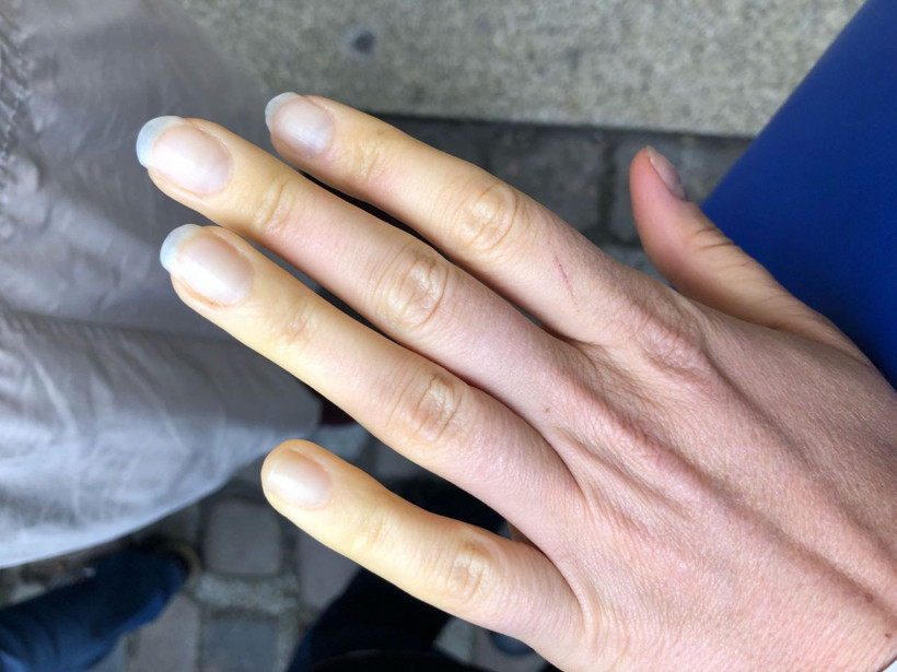 Raynaud fenomeni nedir meslek hastalığı mı damarları etkiliyor! - Resim: 1