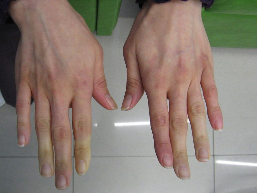 Raynaud fenomeni nedir meslek hastalığı mı damarları etkiliyor! - Resim: 4