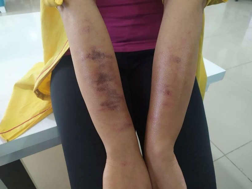 Adıyaman'da güzellik merkezinde lazer epilasyon yaptıran kadının vücudu yandı! - Resim: 2