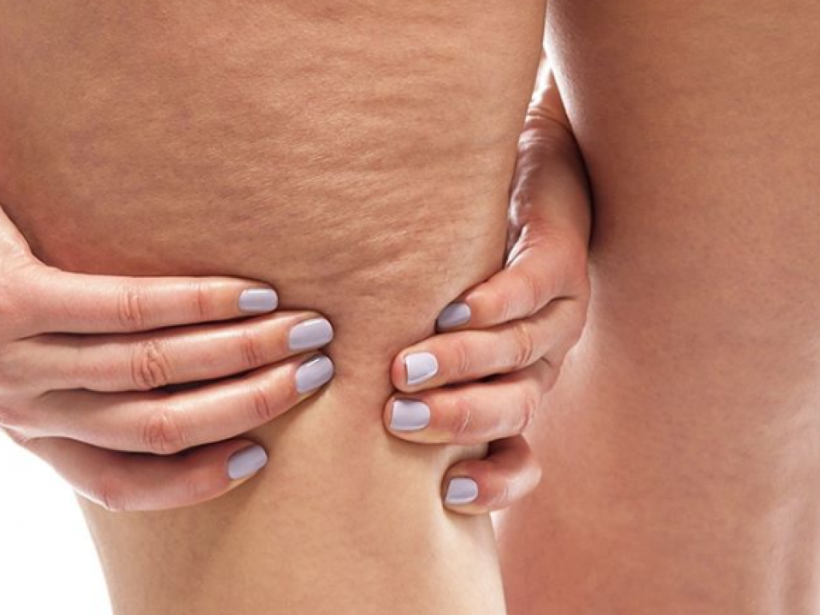 Selülit nedir nasıl tedavi edilir? - Resim: 1