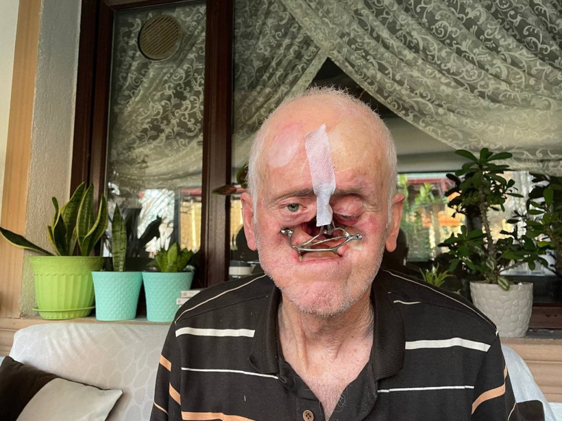 Burnunda çıkan sivilceyle hayatı kabusa döndü! Milim milim eridi, 31 ameliyat geçirdi - Resim: 4