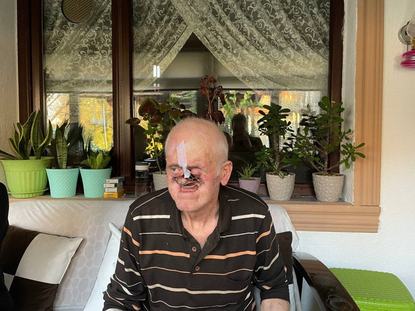 Burnunda çıkan sivilceyle hayatı kabusa döndü! Milim milim eridi, 31 ameliyat geçirdi - Resim: 3