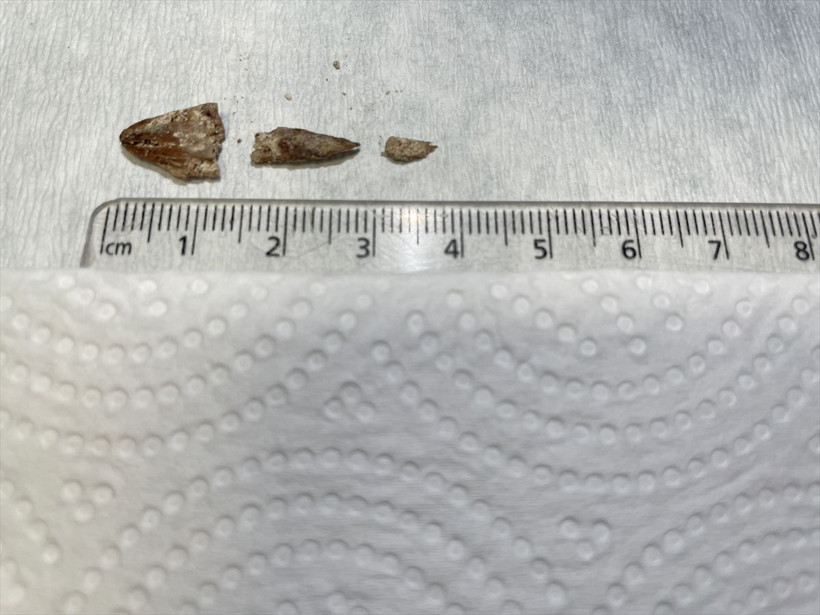 İzmir'de kanser sanılan hastanın soluk borusundan bakın ne çıktı - Resim: 3