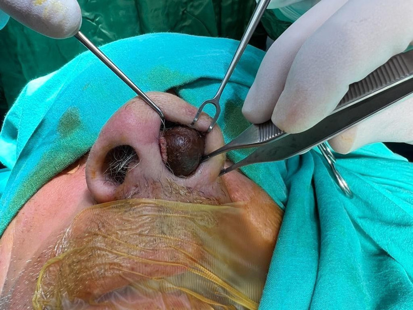 50 yıldır burnunun içindeymiş! 2 saatlik operasyonla çıkarıldı doktor da şoke oldu - Resim: 4