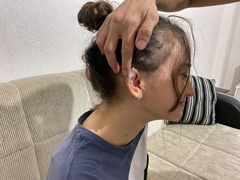 Küpe takmak için takıcıda deldirdiği kulağı hayatını kabusa çevirdi! - Resim: 2
