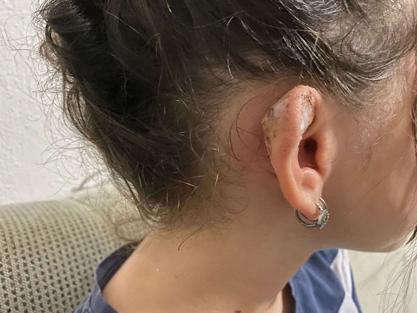 Küpe takmak için takıcıda deldirdiği kulağı hayatını kabusa çevirdi! - Resim: 3