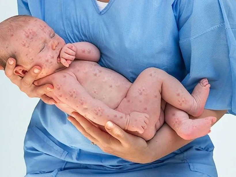 İstanbul'da yeni salgın patladı! Kızamık nedeniyle çocuklar ölmeye başladı! 'Aşı yaptırın' uyarısı geldi - Resim: 3