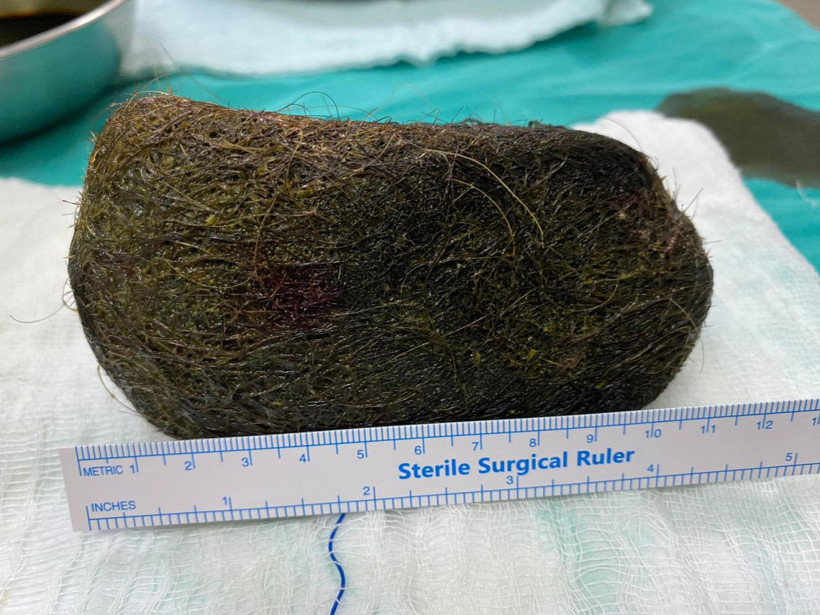 Osmaniye'de bir kadının midesinden 2 kilo saç çıktı - Resim: 3