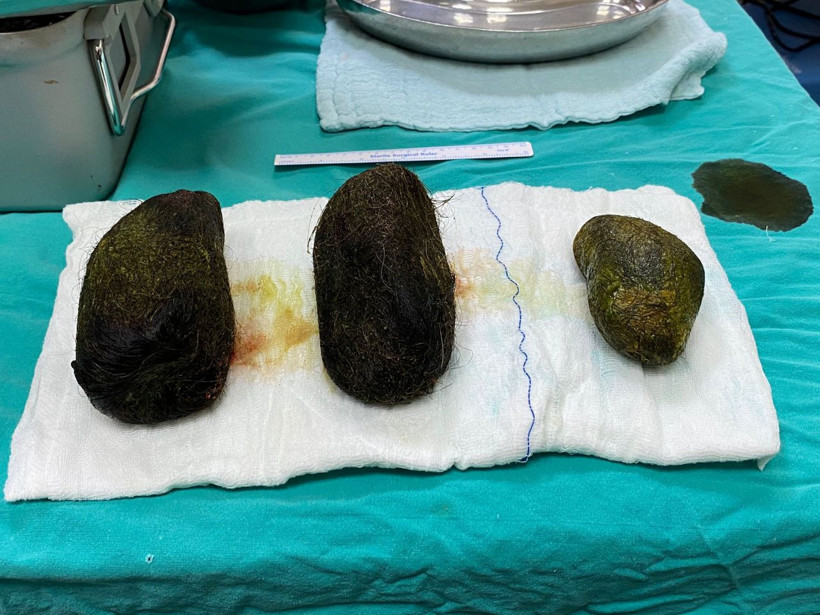 Osmaniye'de bir kadının midesinden 2 kilo saç çıktı - Resim: 4