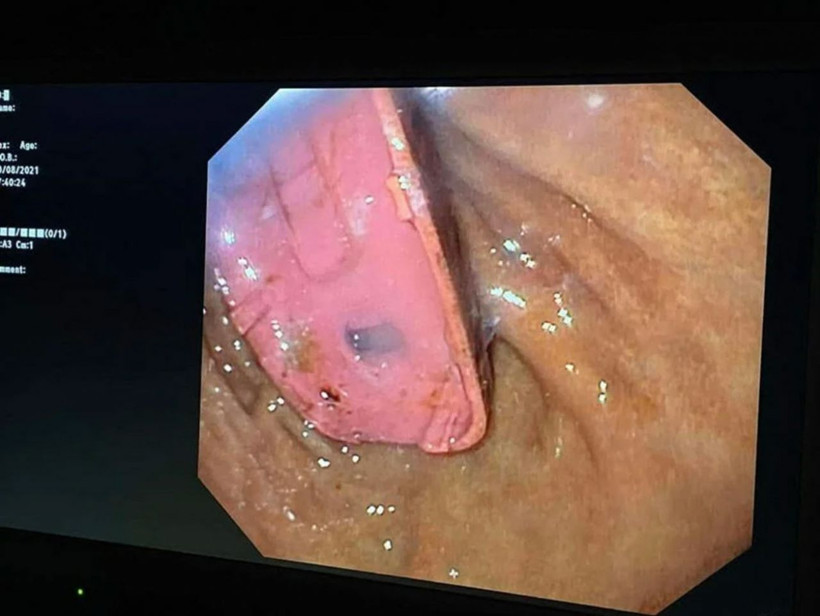 Midesinden Nokia 3310 telefon çıktı! Doktorları şaşırtan ameliyat - Resim: 4